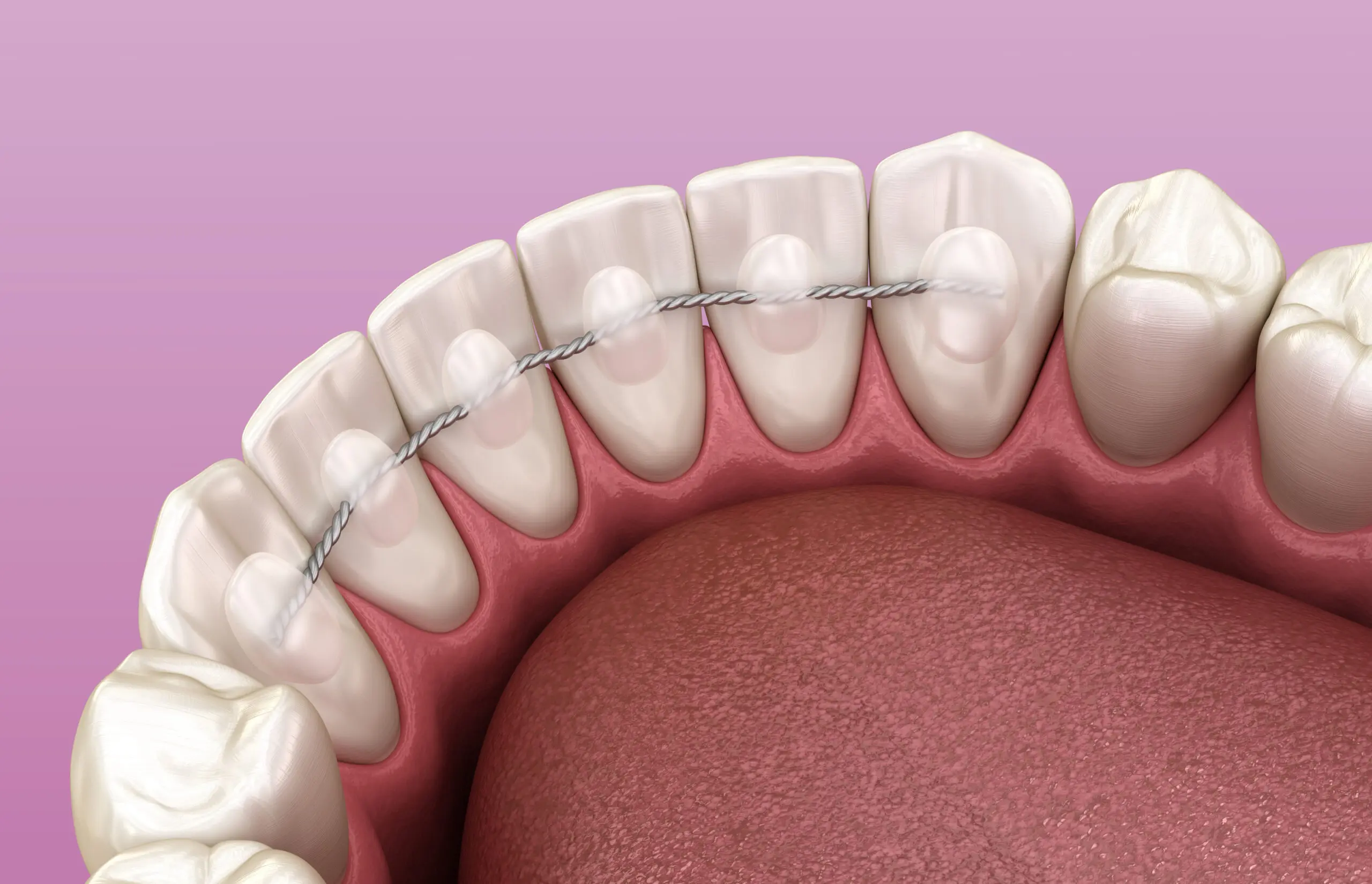 retainer