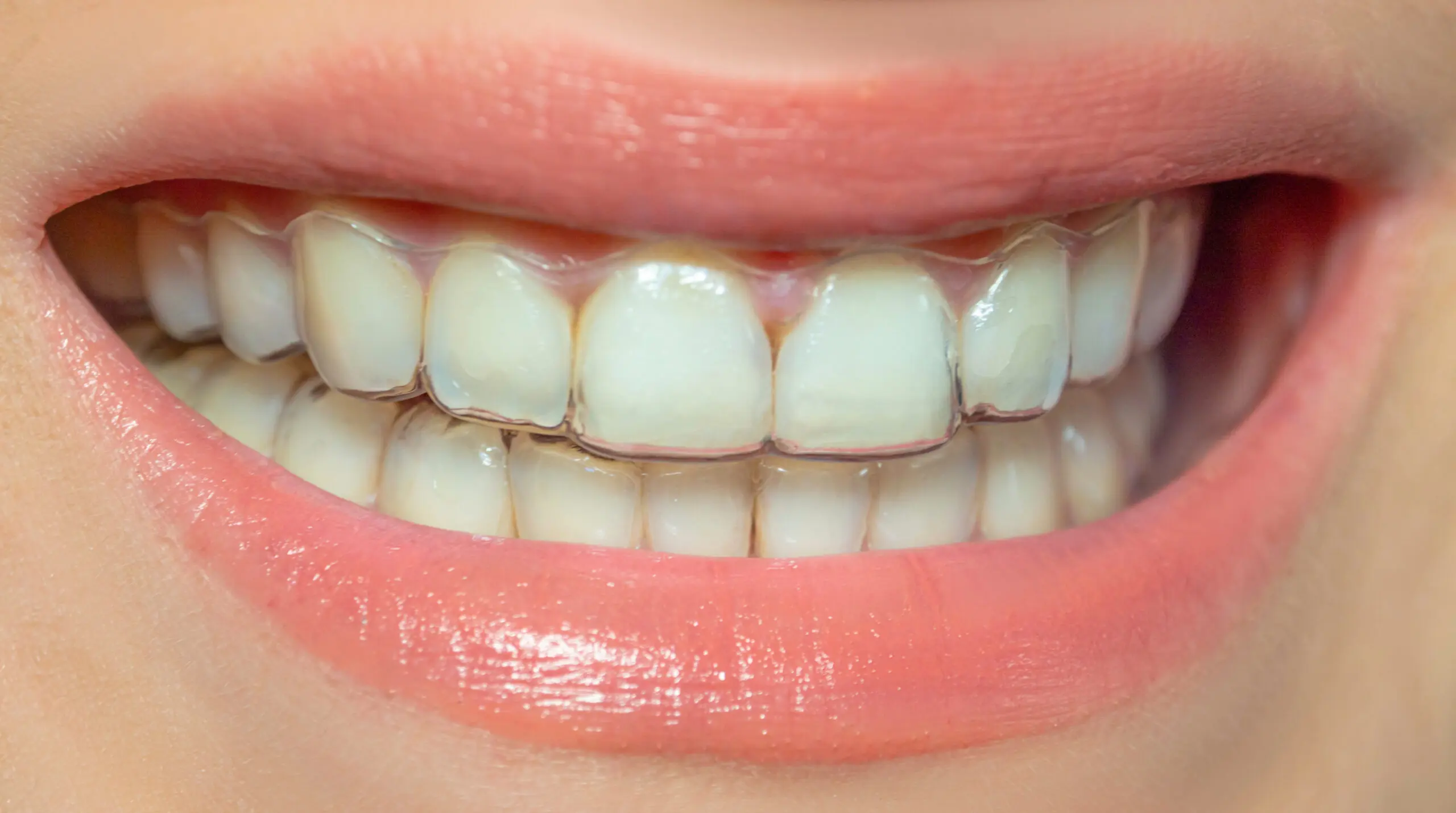 Invisalign in Indianapolis