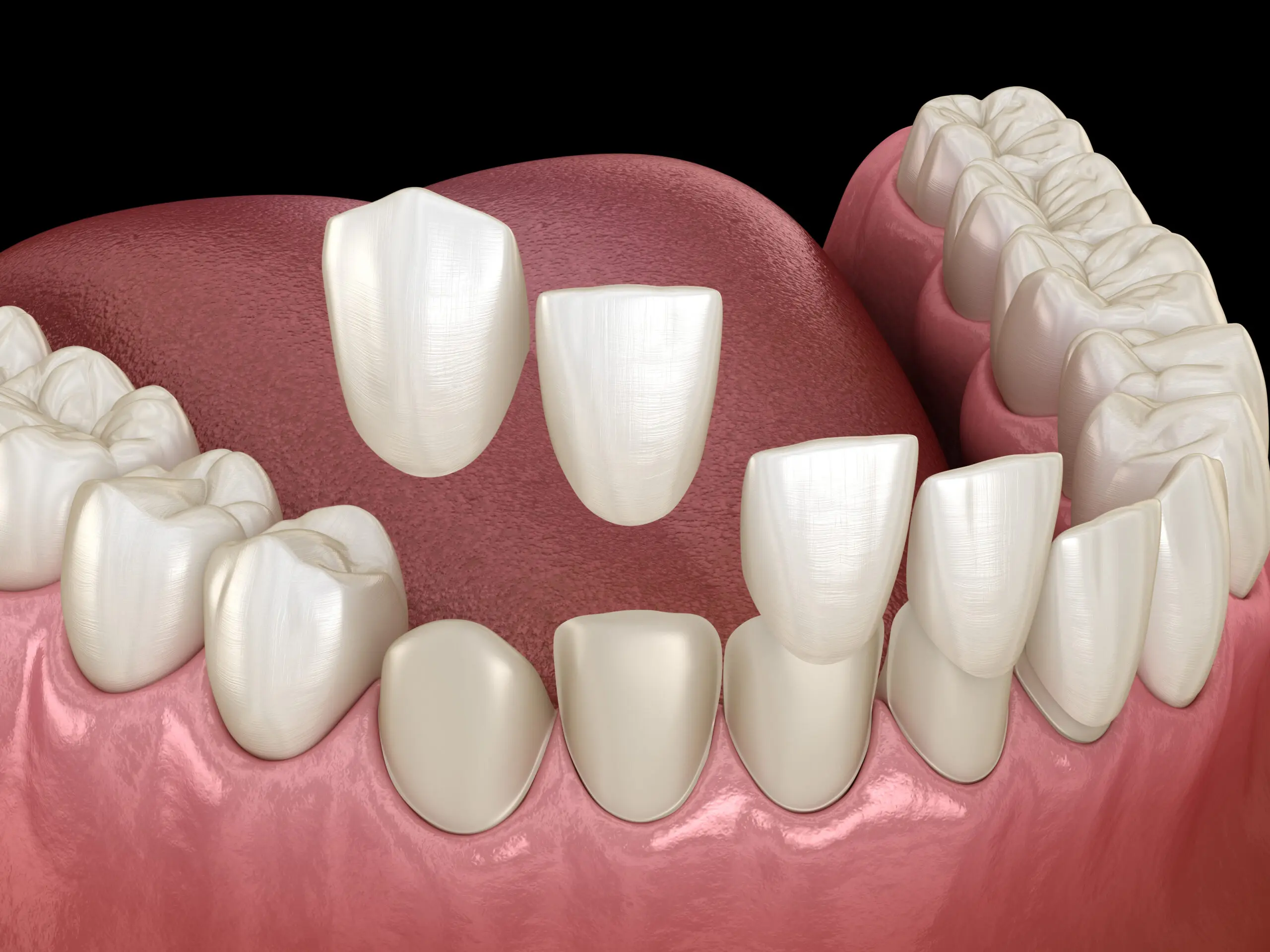 fix chipped teeth