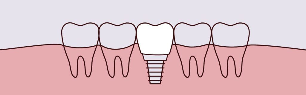 dental implants indianapolis